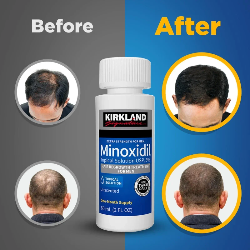 Kirkland Minoxidil 5% Extra Strength – Hair & Beard Growth Solution for Men 8 Kirkland Minoxidil 5% Extra Strength – Hair & Beard Growth Solution for Men - Image 8